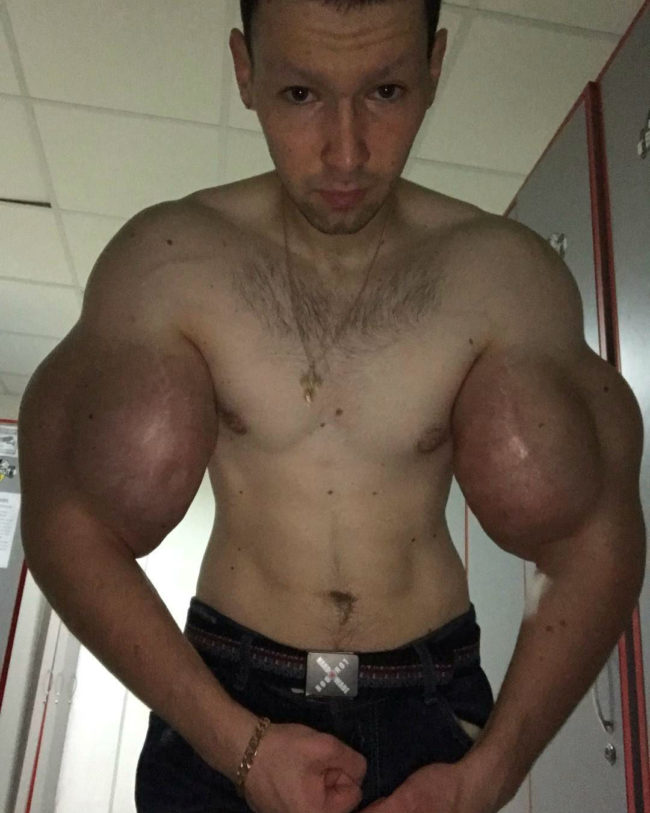 Kirill Tereshin, The “Synthol Kid” Gets Injections In His Cheeks! 1